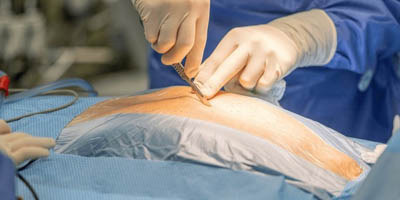 bypass-surgery